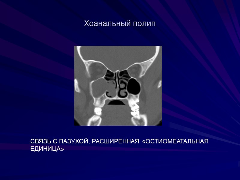 Хоанальный полип СВЯЗЬ С ПАЗУХОЙ, РАСШИРЕННАЯ «ОСТИОМЕАТАЛЬНАЯ ЕДИНИЦА»